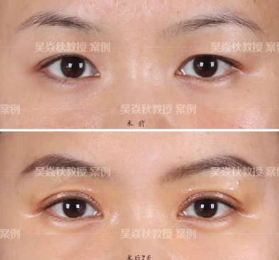 吴焱秋割双眼皮