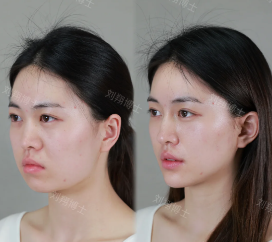 长沙刘翔做面部提升技术怎么样？长沙刘翔面部提升多少钱？