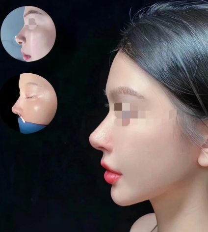 福州隆鼻哪个医生比较好？林峰和张潮哪个隆鼻技术更好？