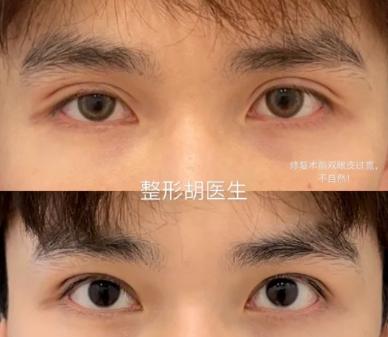 金华双眼皮哪个医生好？胡维君和赵伟做双眼皮哪个好？