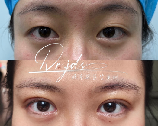 北京姬东硕和宗宪磊哪个做双眼皮好？姬东硕和宗宪磊双眼皮预约电话