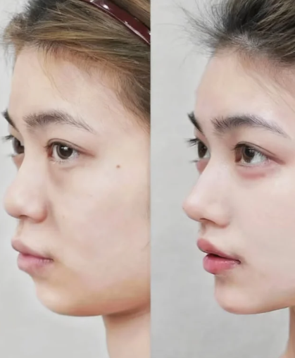 贵阳隆鼻杜良军和陈祥军哪个医生好？杜良军和陈祥军隆鼻预约咨询电话