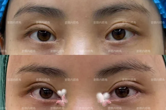 上海曾翾和杨晨光哪个医生回包内眼角技术好？