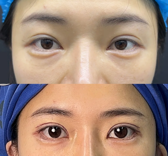 上海眼修复医生杜园园和张楚哪个医生双眼皮修复技术好？