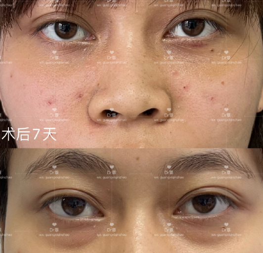 南宁做祛眼袋覃朝和蒙旭昌哪个医生去眼袋比较好？