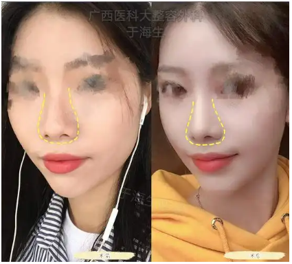 南宁隆鼻于海生和刘泳铖哪个医生做鼻子技术好？