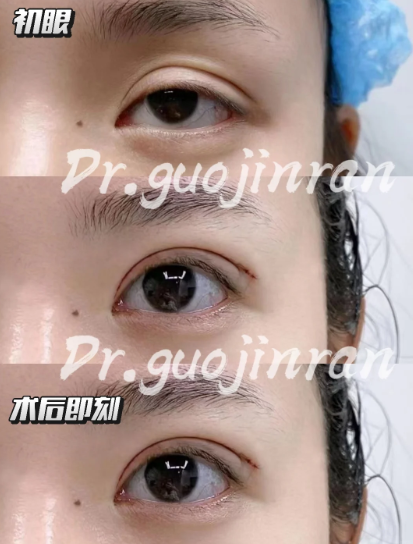 郑州做双眼皮专家郭金冉和孟宝玺割双眼皮哪个好？