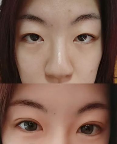 北京八大处林琳和卢建建哪个医生割双眼皮好？