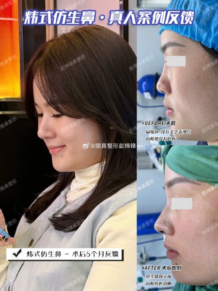 长沙彭炜锋鼻子做的怎么样？彭炜锋做鼻修复吗？