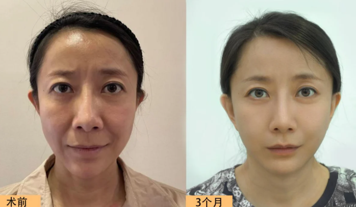 北京面部拉皮提升手术哪个医生做得最好？赵延勇、杜太超、王春虎、袁强