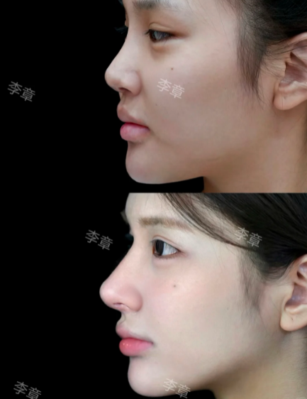 上海隆鼻专家都有哪些？2026年上海隆鼻专家预约排行榜大全