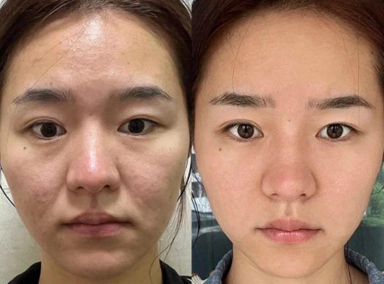 北京王春虎和谢洋春哪个医生做拉皮好？王春虎和谢洋春面部提升口碑谁好？