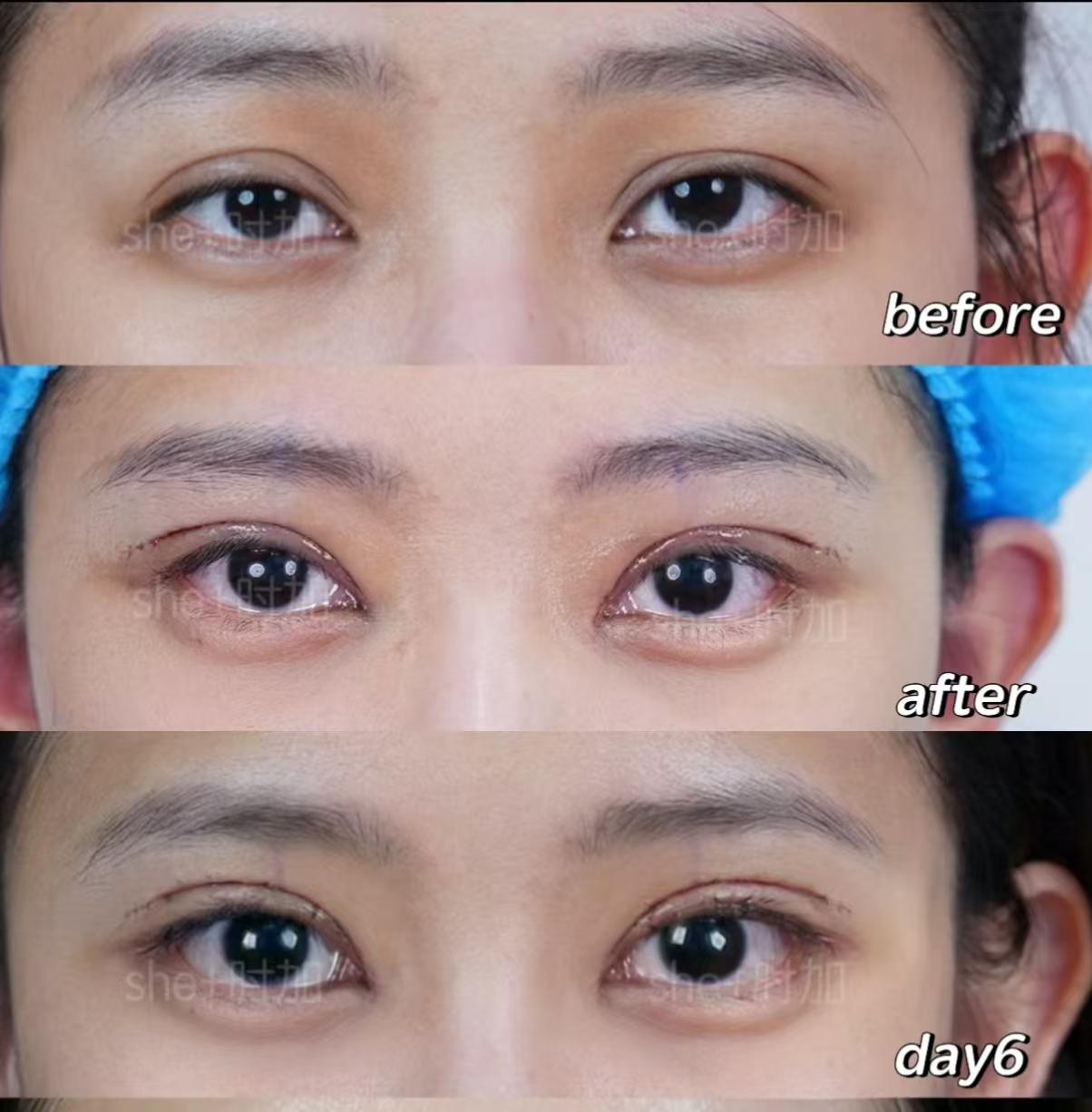 杨海平修复双眼皮案例