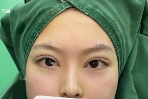 马娟眼修复
