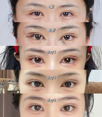 眼修复案例