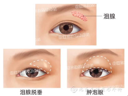 双眼皮肿眼泡是不是去脂肪就可以了呢？