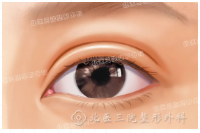 割双眼皮后肉条感比较严重怎么办？可以做眼修复吗？