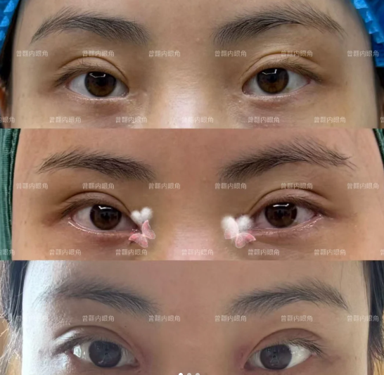 上海曾翾和马娟医生哪个做双眼皮修复技术好？