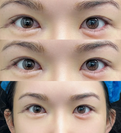 上海眼修复专家刘平和马娟医生哪个做眼修复技术好？