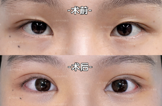 上海眼修复专家卢玲和杨海平哪个修复双眼皮好？