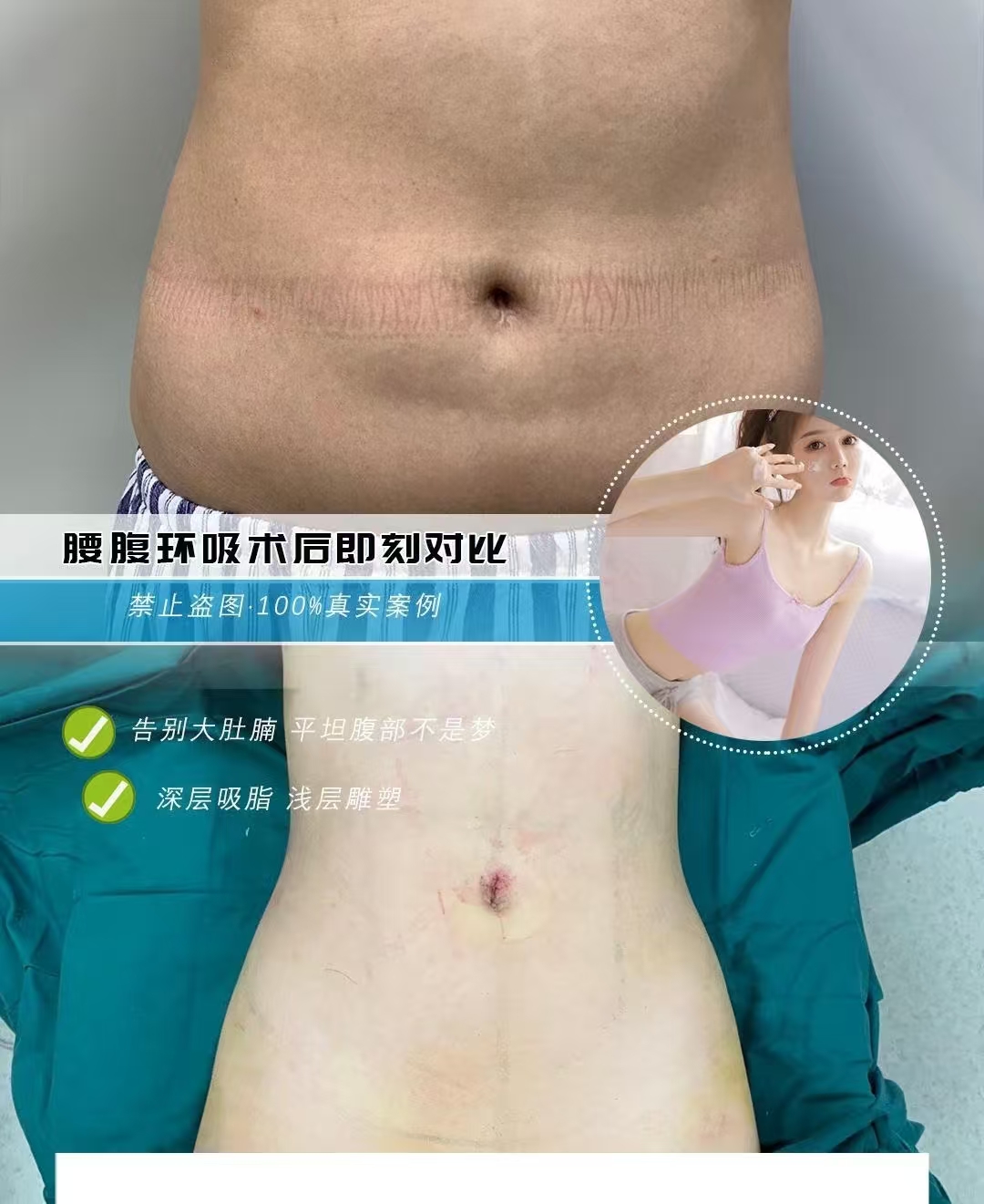 腰腹环吸