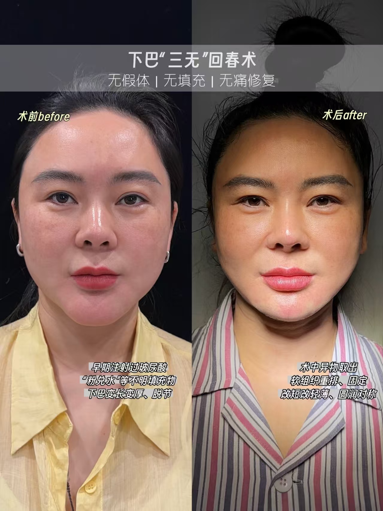 异物取出