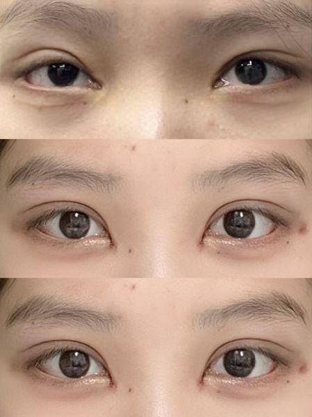 上海双眼皮修复哪个医生最好？佀同帅、刘平、卢玲、马娟、郑小红怎么选？