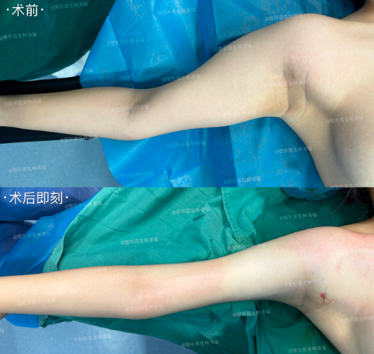 手臂吸脂案例