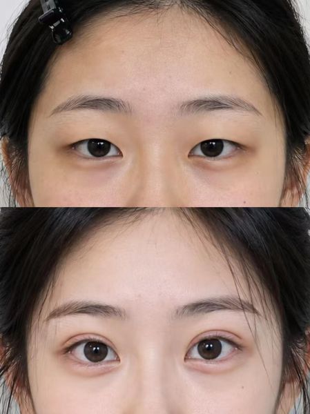 2026年广州双眼皮手术哪个医生比较好？王娟、陈贵宗、李光琴？