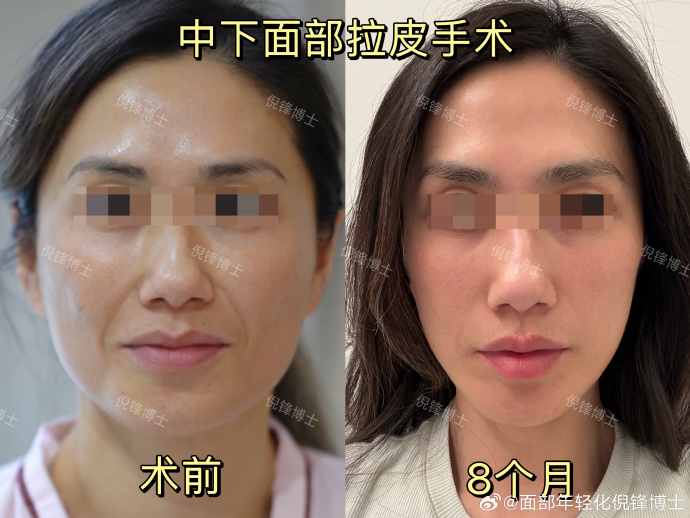 北京假体丰胸医生：林彪斌、王博谦、高超、于双全、马静谁技术最好？