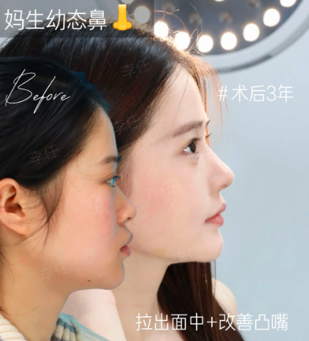鼻综合案例
