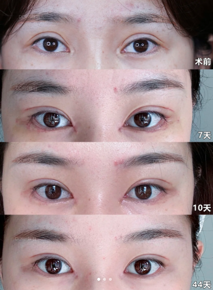 张楚眼修复案例