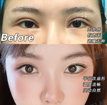 潘贰眼修复案例