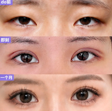 大连双眼皮