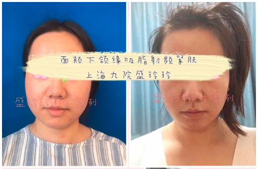 盛玲玲医生吸脂案例