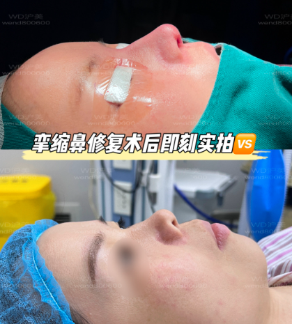 李章隆鼻案例