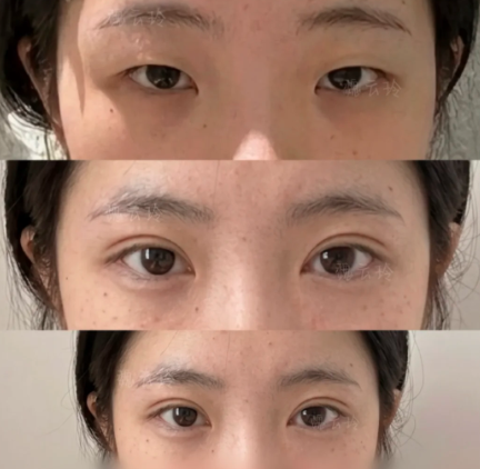 苏州割双眼皮戴三友和杨慧婷哪个医生做双眼皮技术好？