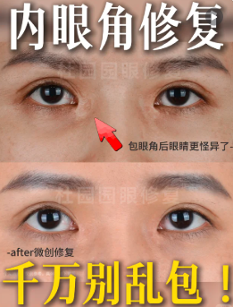 国内双眼皮修复杜园园和潘贰哪个医生技术更好？