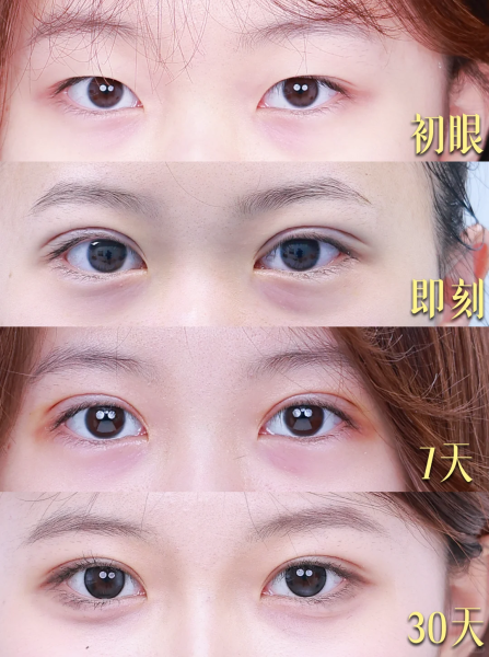天津知名的双眼皮医生都有谁？2026年天津双眼皮专家预约排行榜大全