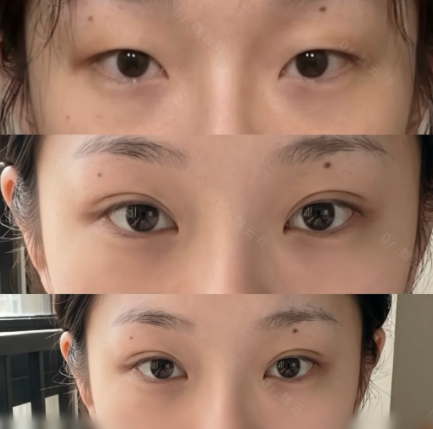 上海魏云玲和杨洪波割双眼皮哪个好？魏云玲和杨洪波双眼皮对比预约