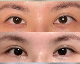 顾钏眼修复案例