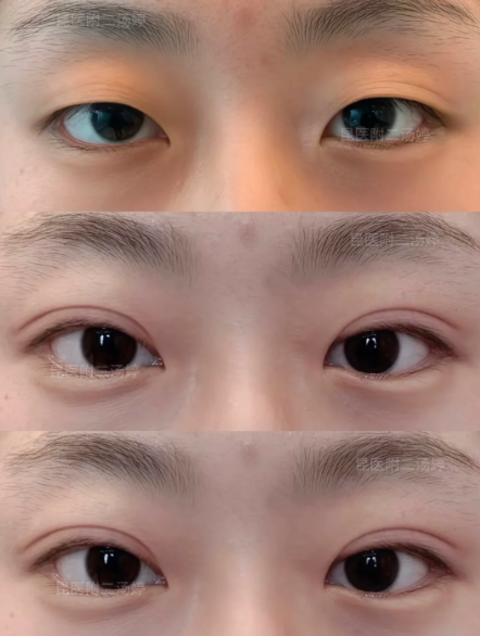 汤婷割双眼皮案例