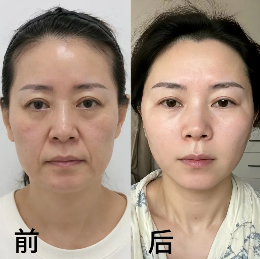 上海九院拉皮案例