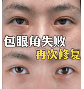 杜园园包眼角案例