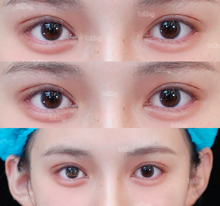 双眼皮案例