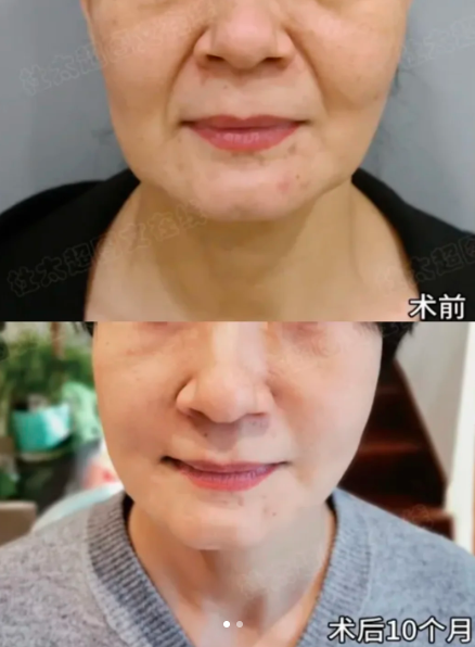 拉皮案例