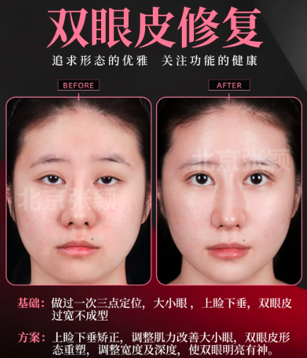 双眼皮修复案例