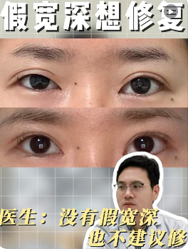 双眼皮修复案例