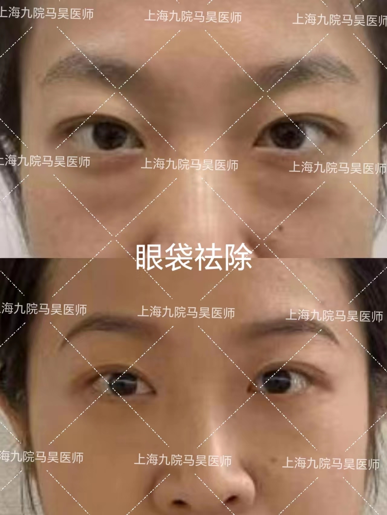 马昊祛眼袋案例