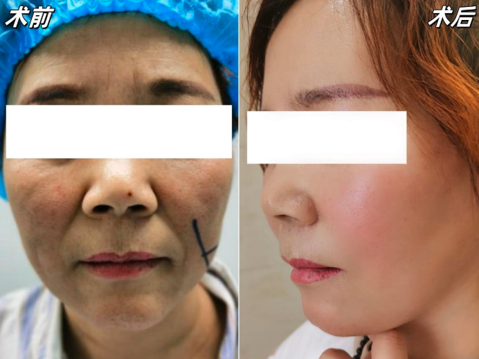 温志华拉皮案例